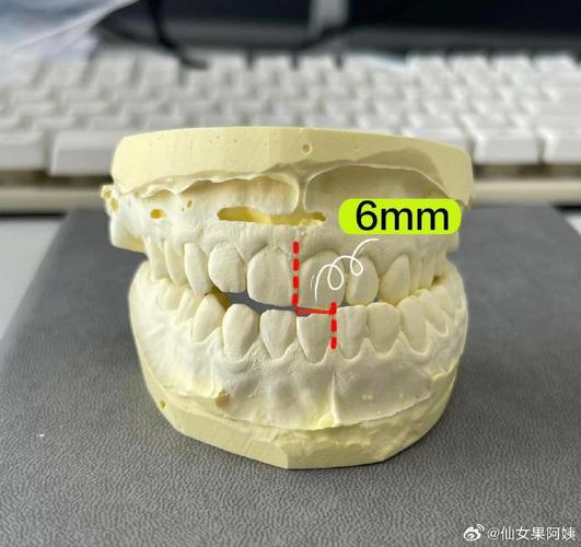 正畸都要做牙模吗-图1