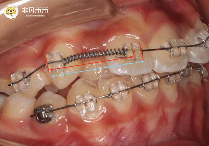 正畸中推簧的作用-图2