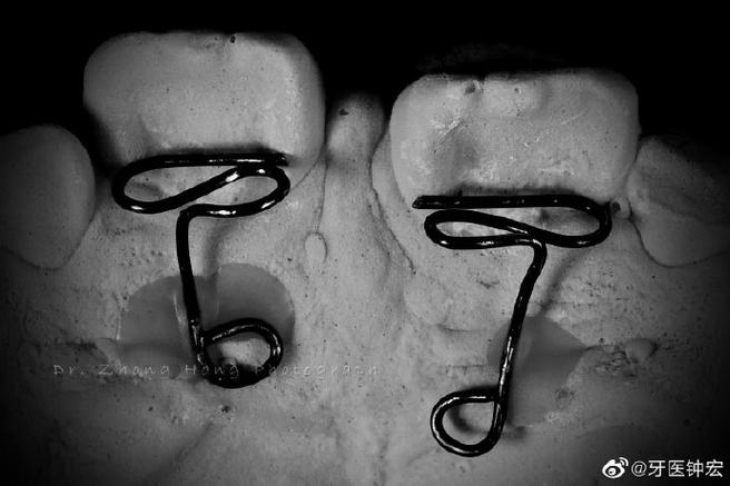 正畸双曲舌簧制作-图3 正畸双曲舌簧制作-图3