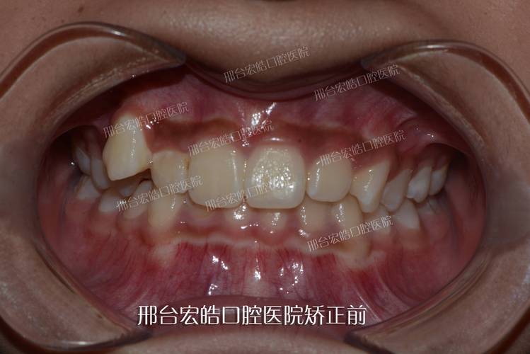 正畸虎牙脸会垮吗-图3 正畸虎牙脸会垮吗-图3