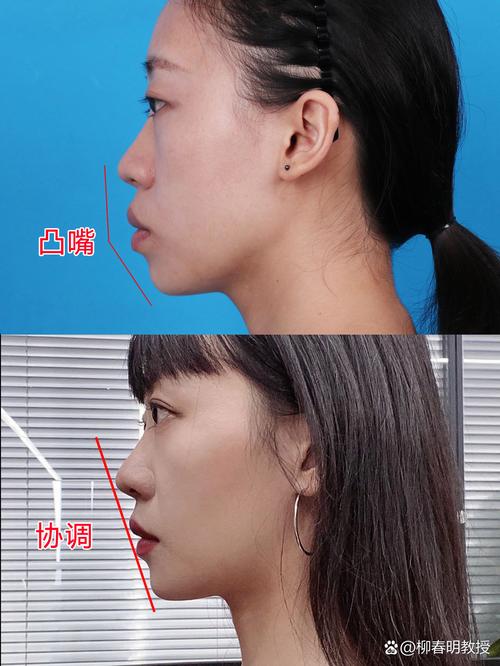 双颚前突可以正畸-图1 双颚前突可以正畸-图1