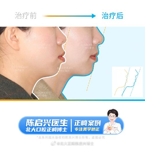 双颚前突可以正畸-图2 双颚前突可以正畸-图2