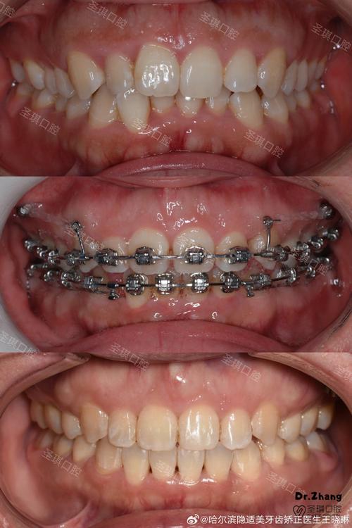 口腔科下颌骨正畸-图1 口腔科下颌骨正畸-图1