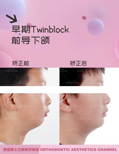 口腔科下颌骨正畸-图2 口腔科下颌骨正畸-图2