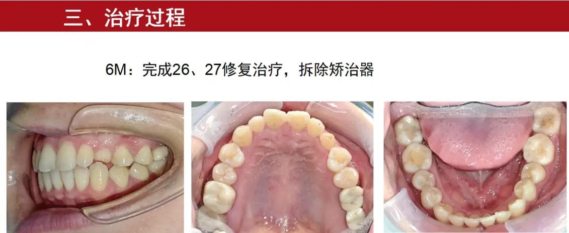 正畸病例中生长期-图3