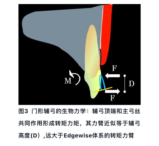 正畸门型辅弓图片-图1