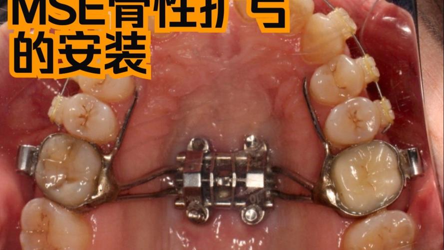 正畸门型辅弓图片-图2