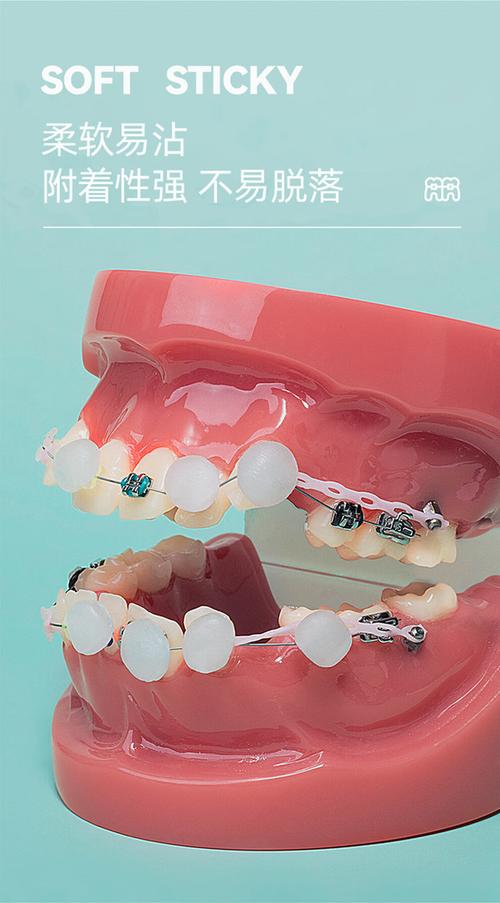 正畸蜡会美观点吗-图1 正畸蜡会美观点吗-图1