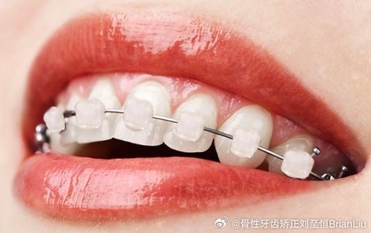 正畸蜡会美观点吗-图3 正畸蜡会美观点吗-图3