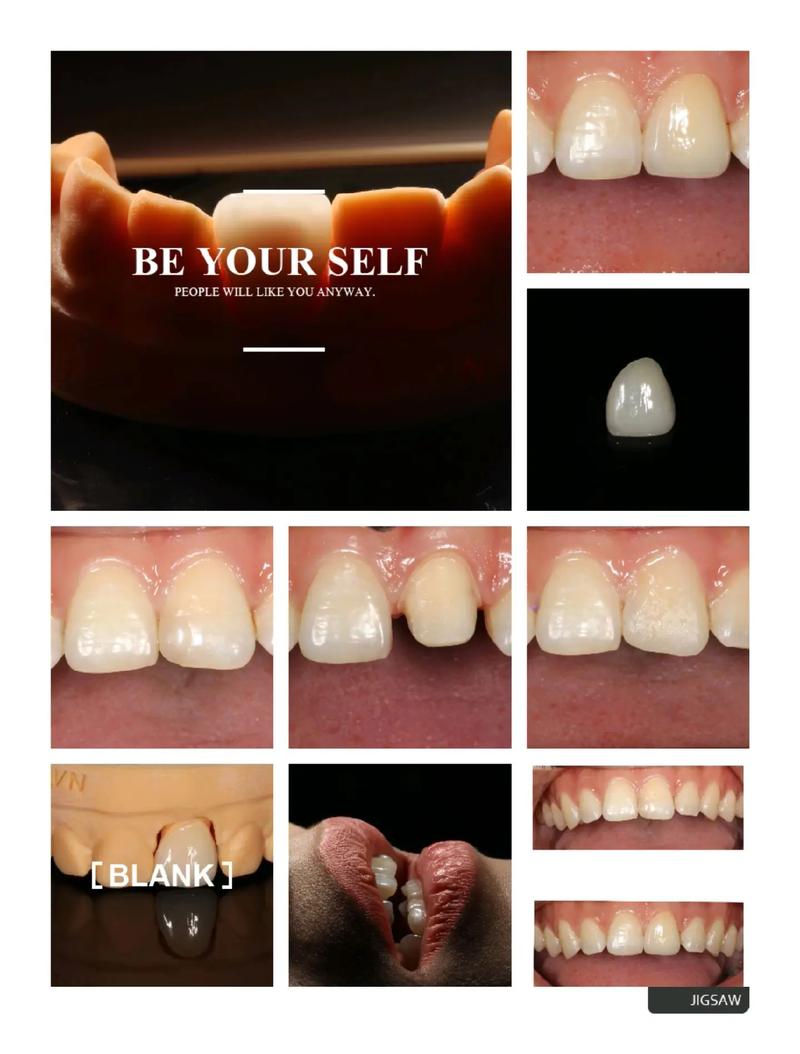 正畸时做冠修复会影响牙齿移动吗？-图2