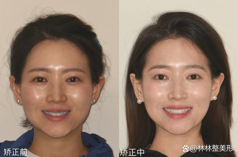 正畸后牙前移脸凹-图1