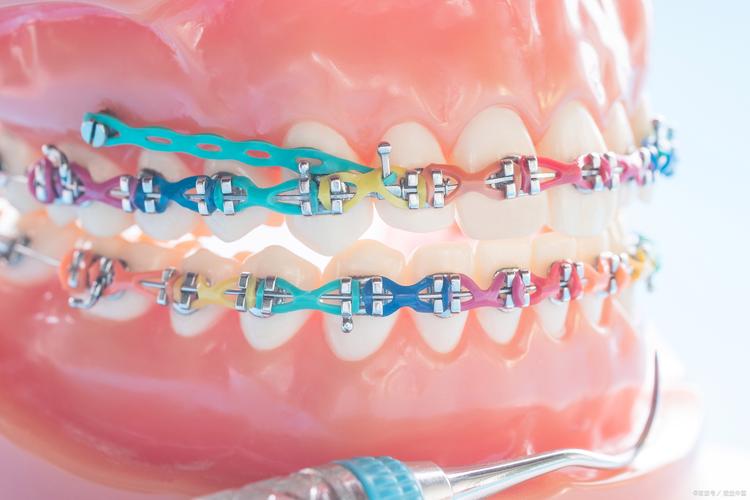 正畸固定期间疼吗-图3