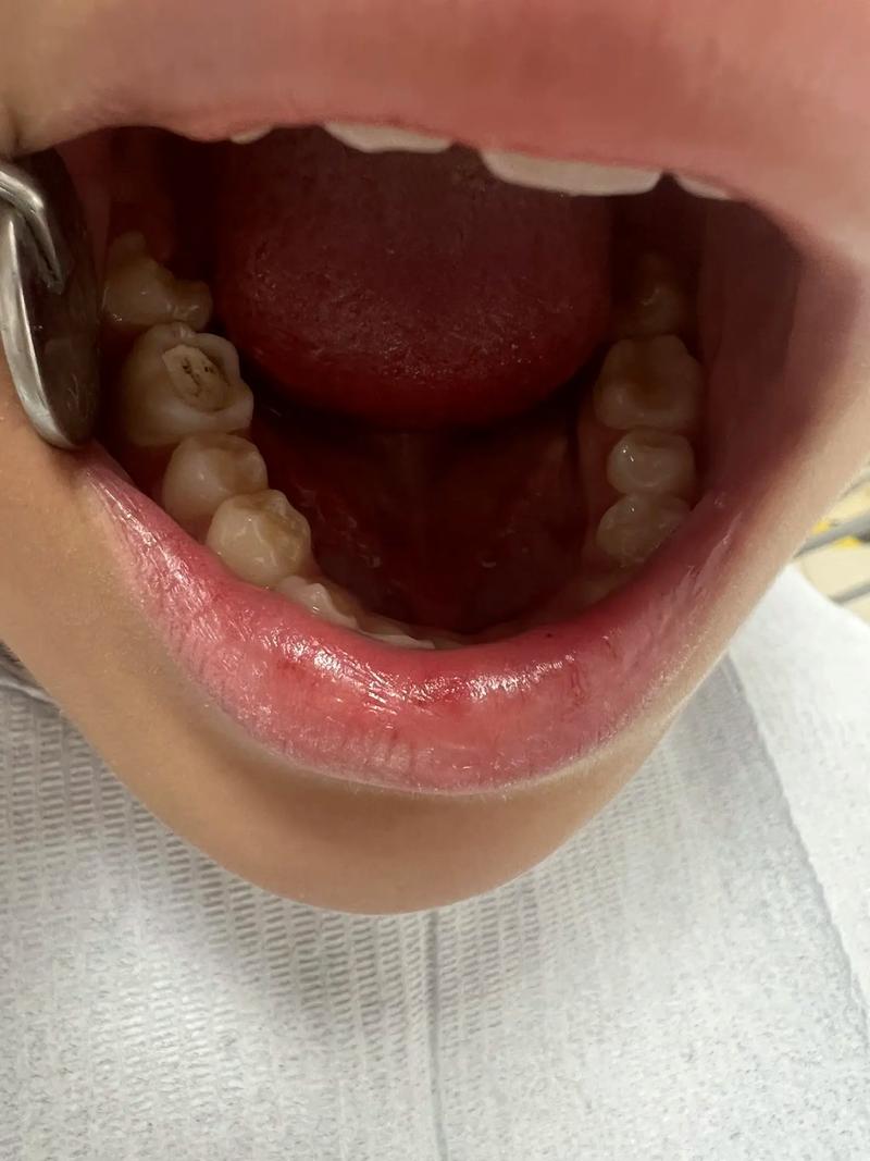 邻面去釉正畸效果如何？安全性与持久性怎么样？-图2