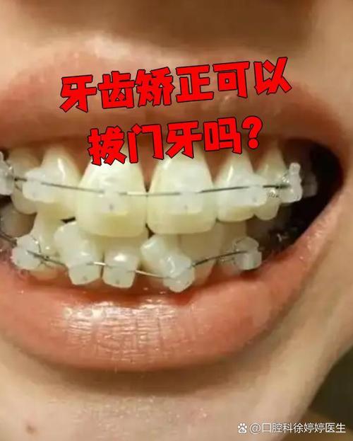 正畸把门牙往下拉-图2 正畸把门牙往下拉-图2