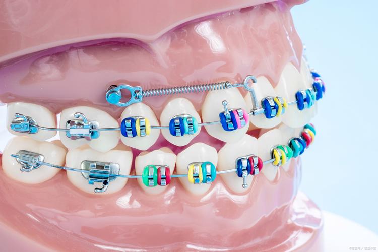 摇摆式矫治器正畸-图1