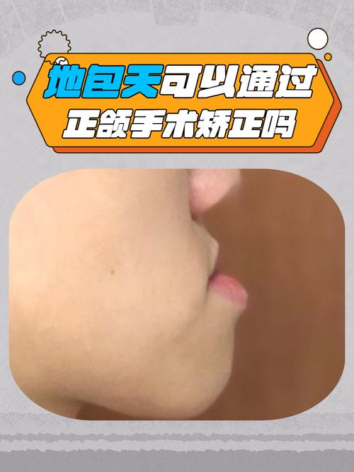 正畸形结束再正颌-图1 正畸形结束再正颌-图1