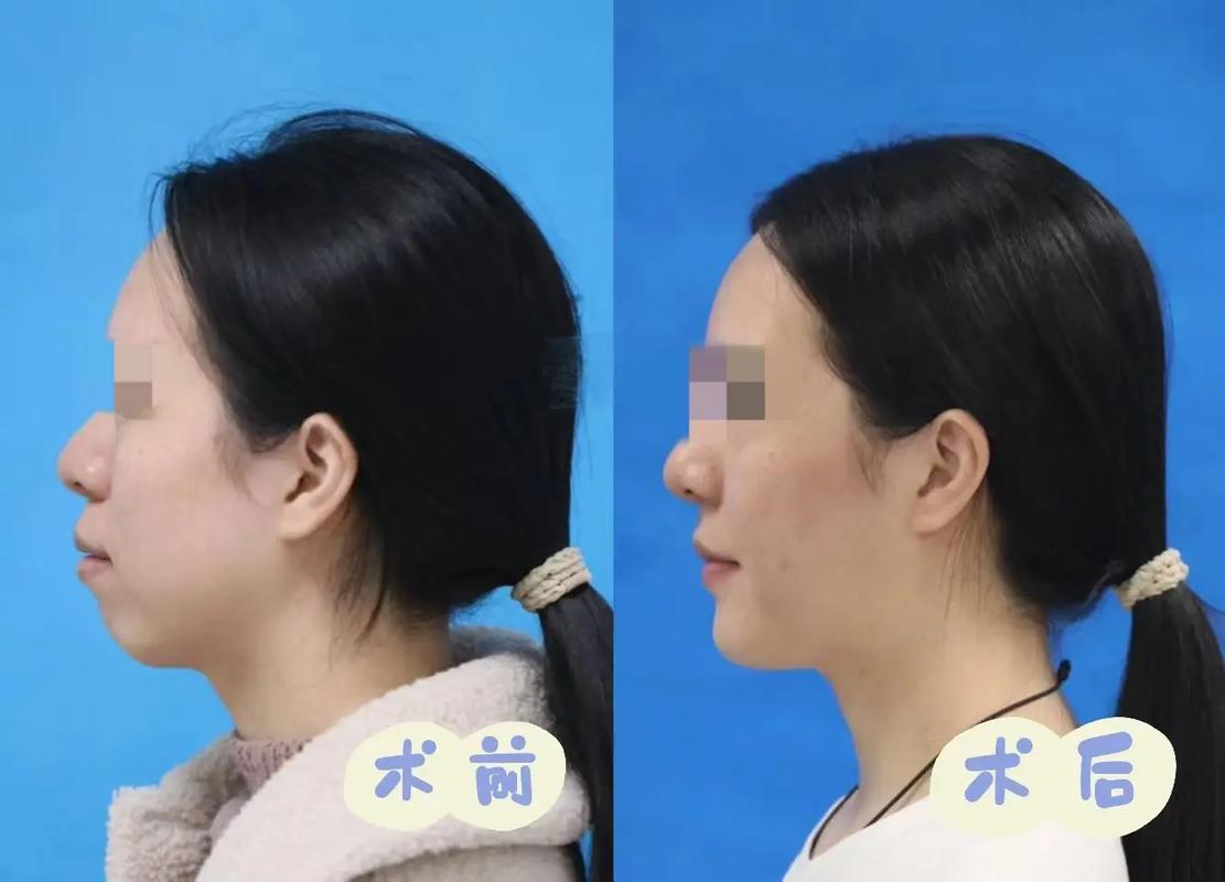 正畸形结束再正颌-图3 正畸形结束再正颌-图3