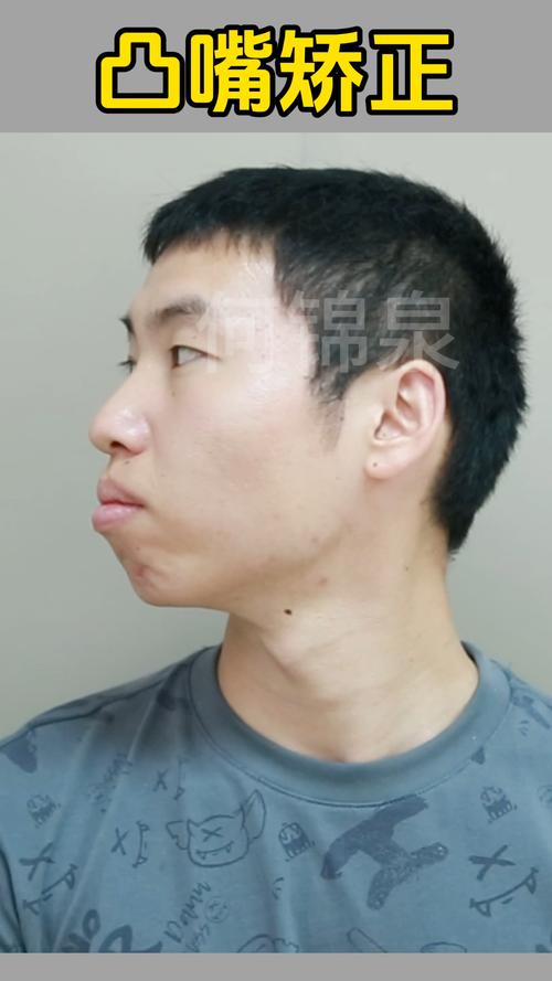 正颌后为何必须正畸？不做的后果是什么？-图2