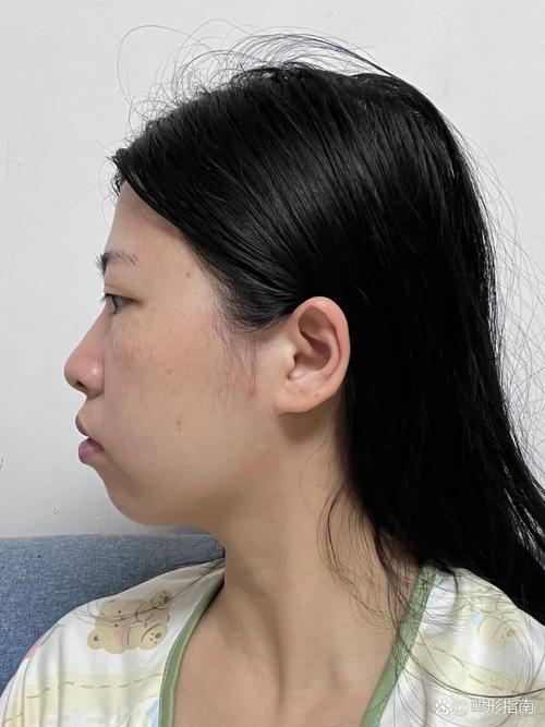 正颌后为何必须正畸？不做的后果是什么？-图1