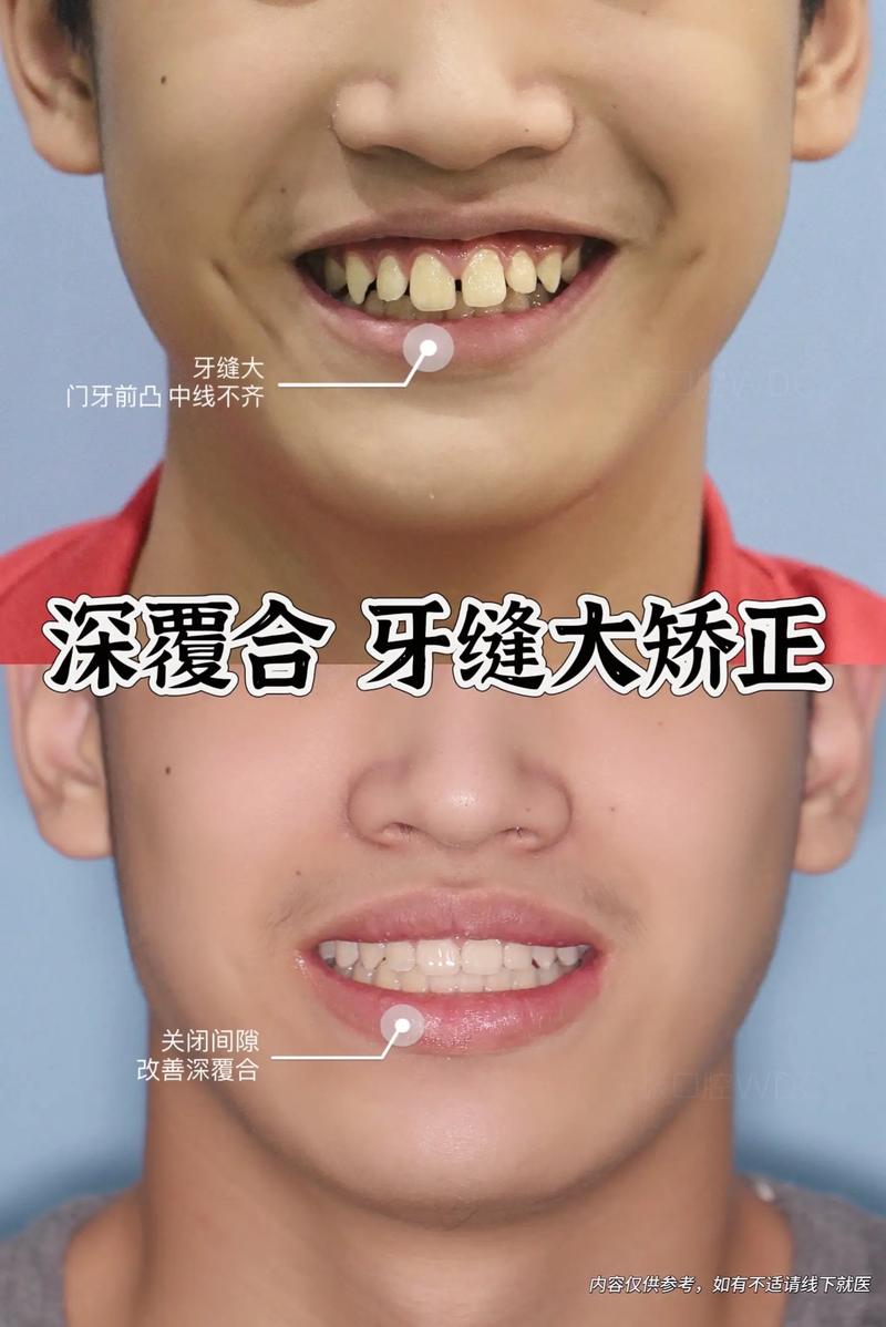 深覆颌牙正畸治疗-图1 深覆颌牙正畸治疗-图1