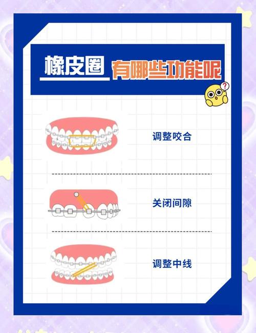 正畸橡皮圈的选择-图1 正畸橡皮圈的选择-图1