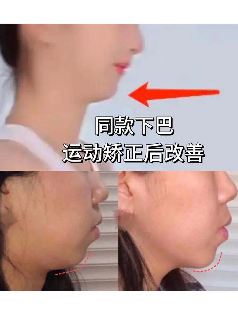 正颌后必须正畸吗-图1