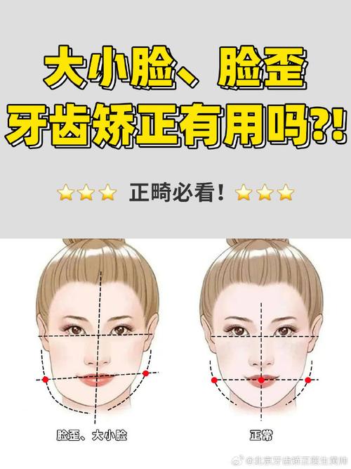 正畸改变脸大小吗-图2 正畸改变脸大小吗-图2