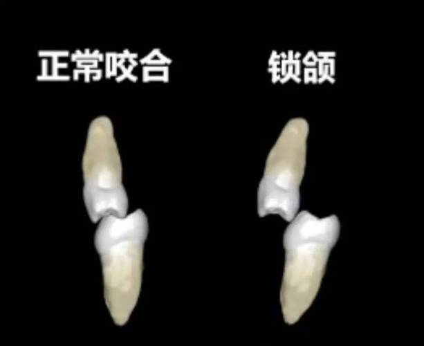 锁合不好不想正畸-图2