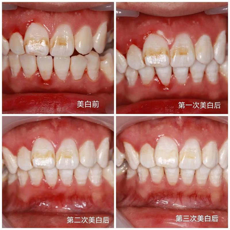 氟斑牙可以正畸嘛-图1 氟斑牙可以正畸嘛-图1