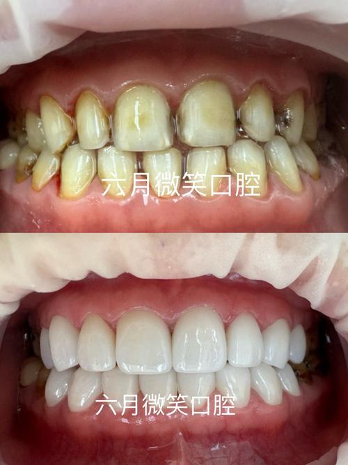 氟斑牙可以正畸嘛-图2 氟斑牙可以正畸嘛-图2