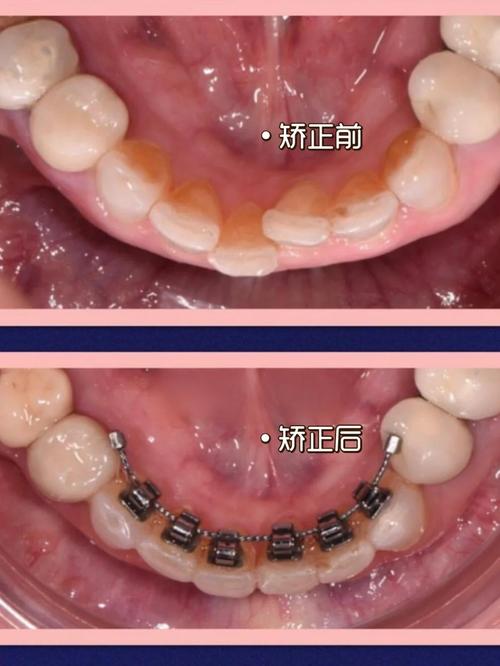 长春有舌侧正畸吗-图1