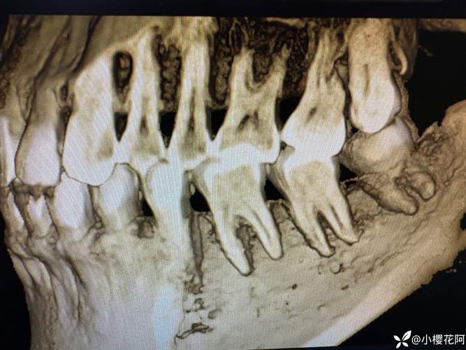 二次正畸牙根吸收-图1