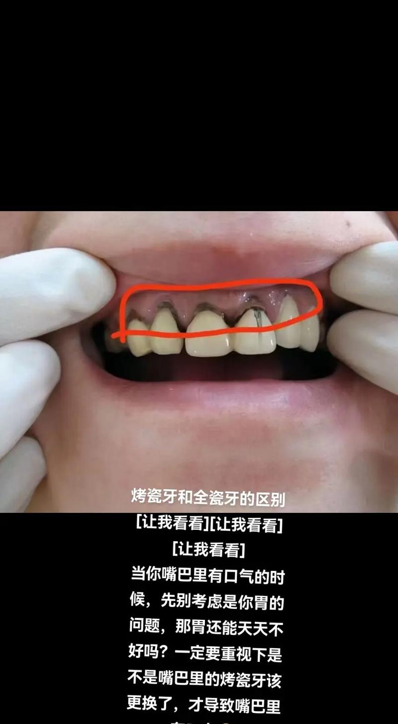 牙齿正畸和烤瓷牙有何区别？哪种情况更适合选择？-图3