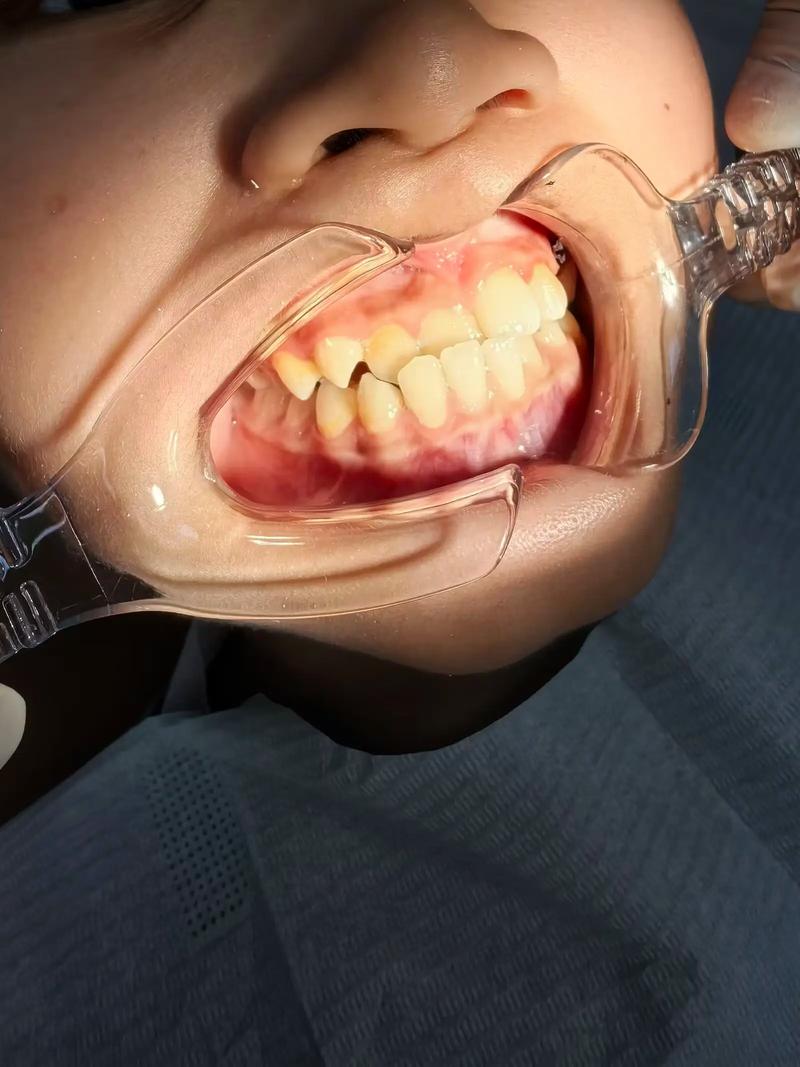 正畸矫正如何调整咬合关系?拉出来指什么?-图1 正畸矫正如何调整咬合关系?拉出来指什么?-图1