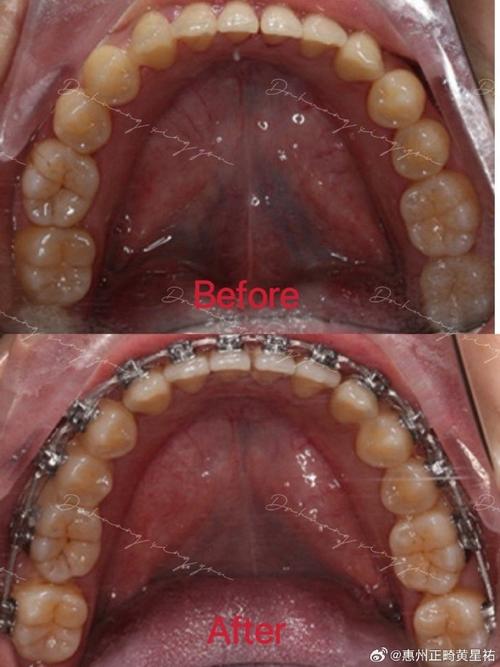 正畸矫正如何调整咬合关系?拉出来指什么?-图3 正畸矫正如何调整咬合关系?拉出来指什么?-图3