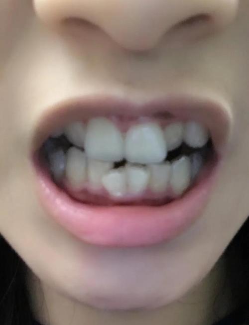 正畸过程中不适感因何而来?如何科学缓解才能更舒适?-图2 正畸过程中不适感因何而来?如何科学缓解才能更舒适?-图2