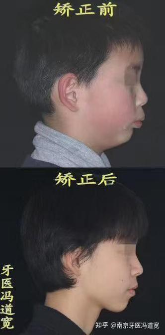口腔儿童反颌正畸-图2