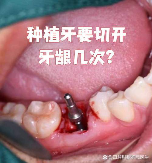 正畸和种牙，到底要不要一起做？先做哪个好？-图2