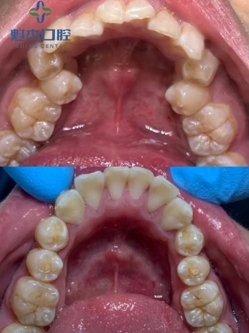 正畸方丝移位戳肉-图2