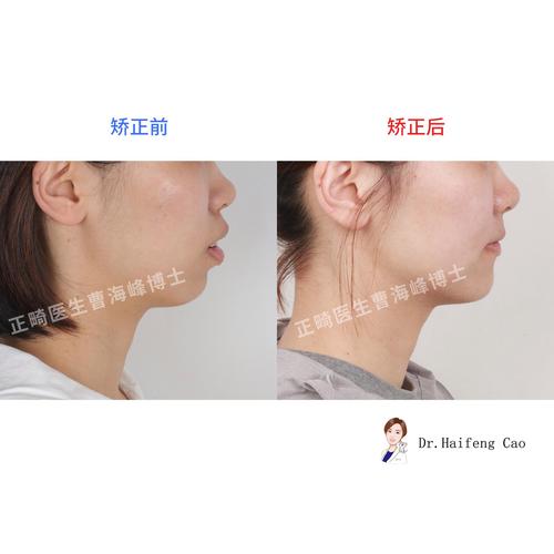 骨性前突做牙齿正畸，矫正效果能好吗？-图2