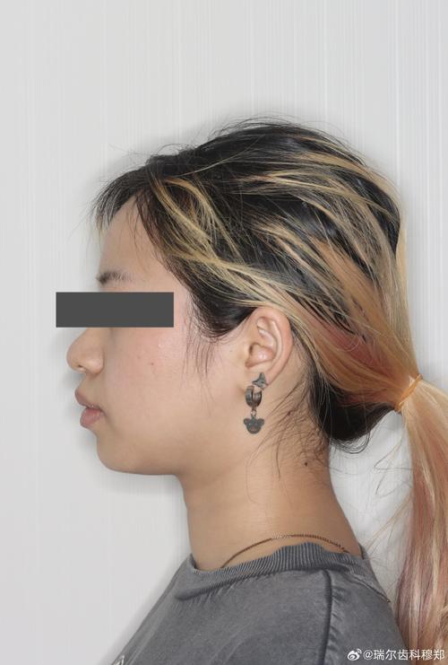 骨性前突做牙齿正畸，矫正效果能好吗？-图1