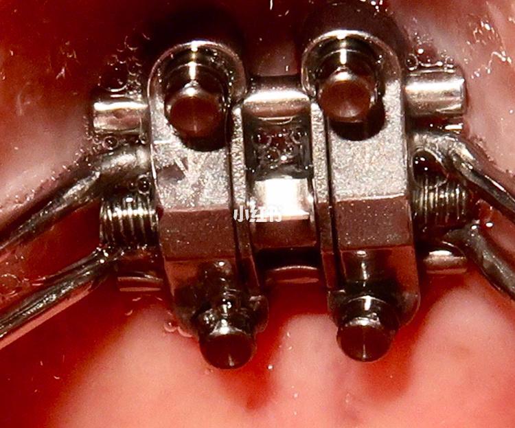 二次正畸必用种植钉吗？作用与风险解析-图2