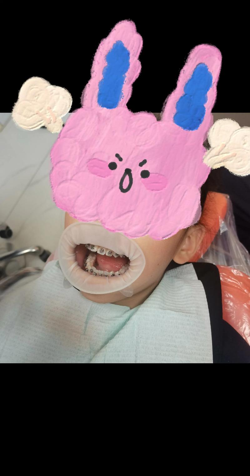 过小牙正畸怎么做-图3