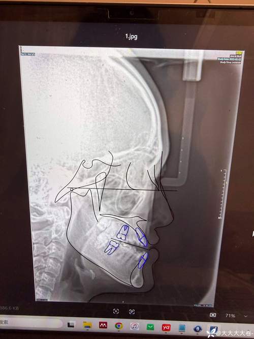 正畸头影测量z角-图2