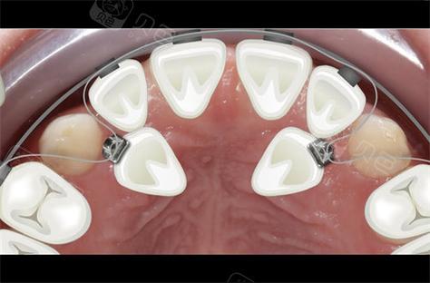 口腔正畸牵引力量-图2