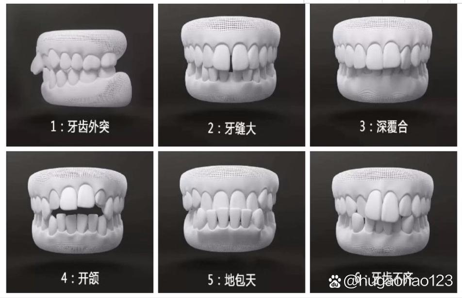 正畸安式错颌分类-图2