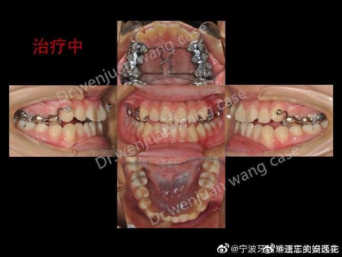 正畸正颌联合治疗，如何协同改善咬合与面部美观？-图2