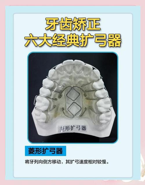 什么是正畸扩工器-图2