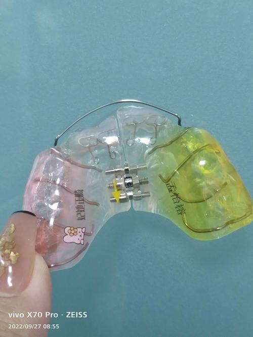 什么是正畸扩工器-图3