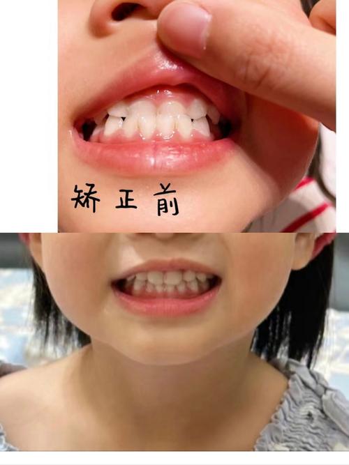 地包天正畸哪里好-图2